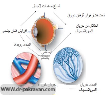 فاکتورهای غیر از فشار چشم در ایجاد گلوکوم